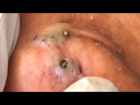 lots of big blackheads behind the ears... satisfying video