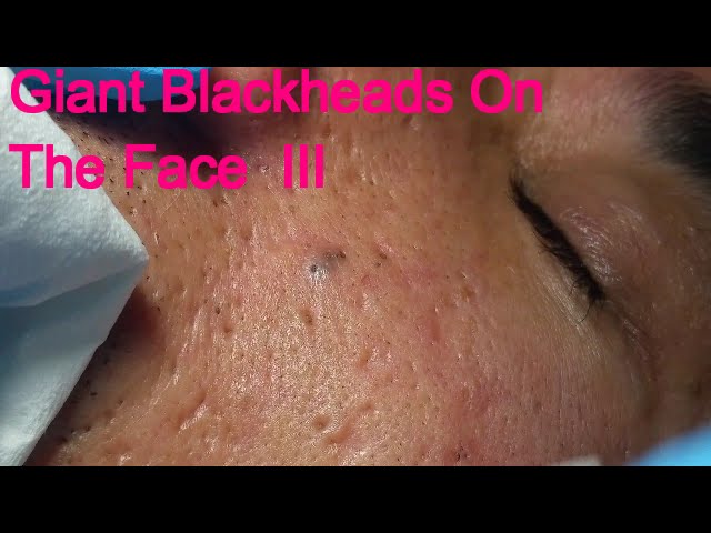 Giant Blackheads - Part III -